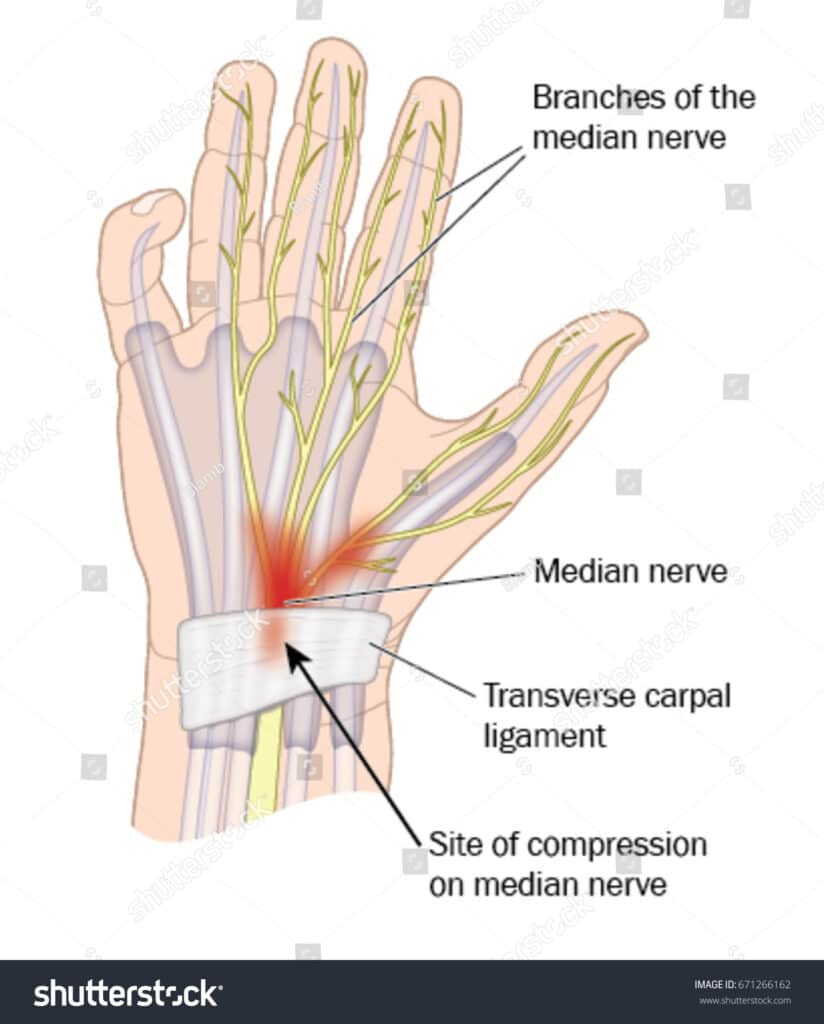 Carpal Tunnel Utah, pain management